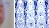 Doctor looking at a patient's CT scan